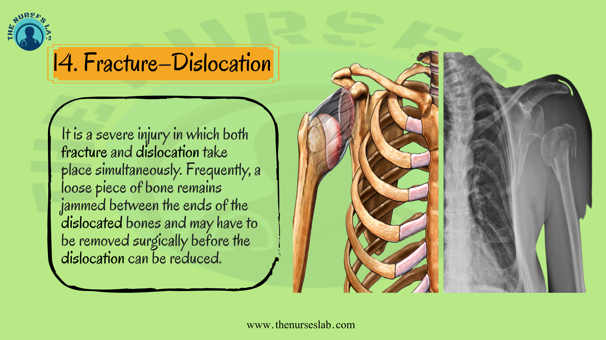Types of Bone Fracture