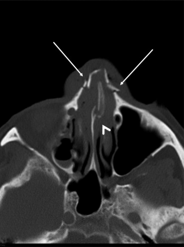 Nasal Bone Anatomy Ct Radiology : Technology and Techniques in