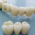 Ưu và nhược điểm của các loại răng sứ thẩm mỹ