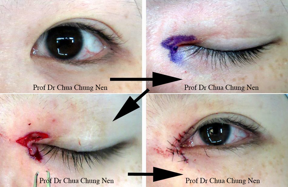 Eyelid Surgery By Prof Dr Cn Chua 蔡鐘能 Doc Do I Need Operation On My