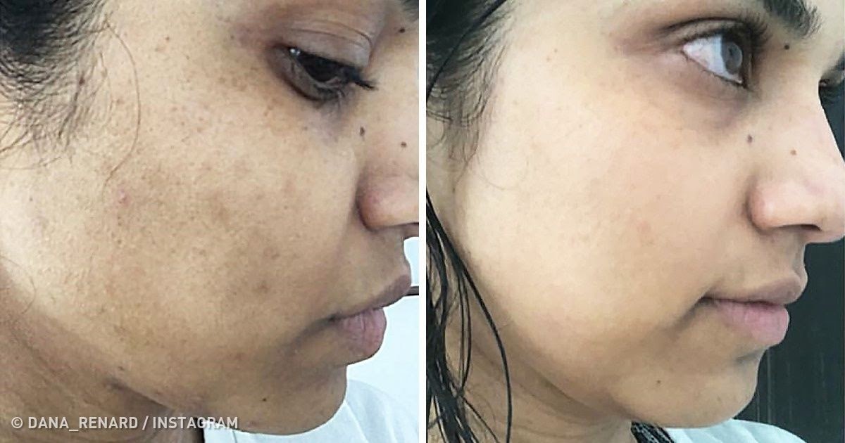 Naturally Remove Brown Spots on Face How to Get Rid of Them Naturally