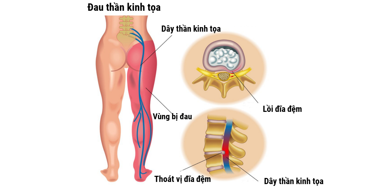 Đau dây thần kinh tọa phải làm sao?