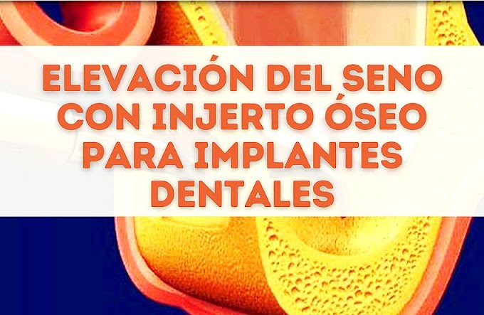 ELEVACIÓN DEL SENO con injerto óseo para Implantes dentales