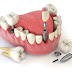 Trồng răng implant ở đâu tốt? Có đau không?