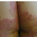 Obat Gatal Dermatitis atau scabies di selangkangan 