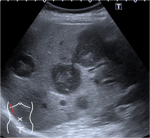 medical-ultrasound-liver-metastasis
