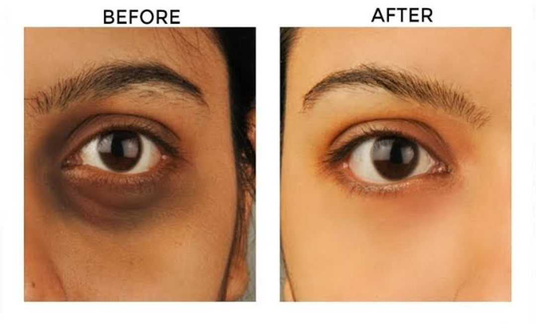 How to get rid of dark circles permanently