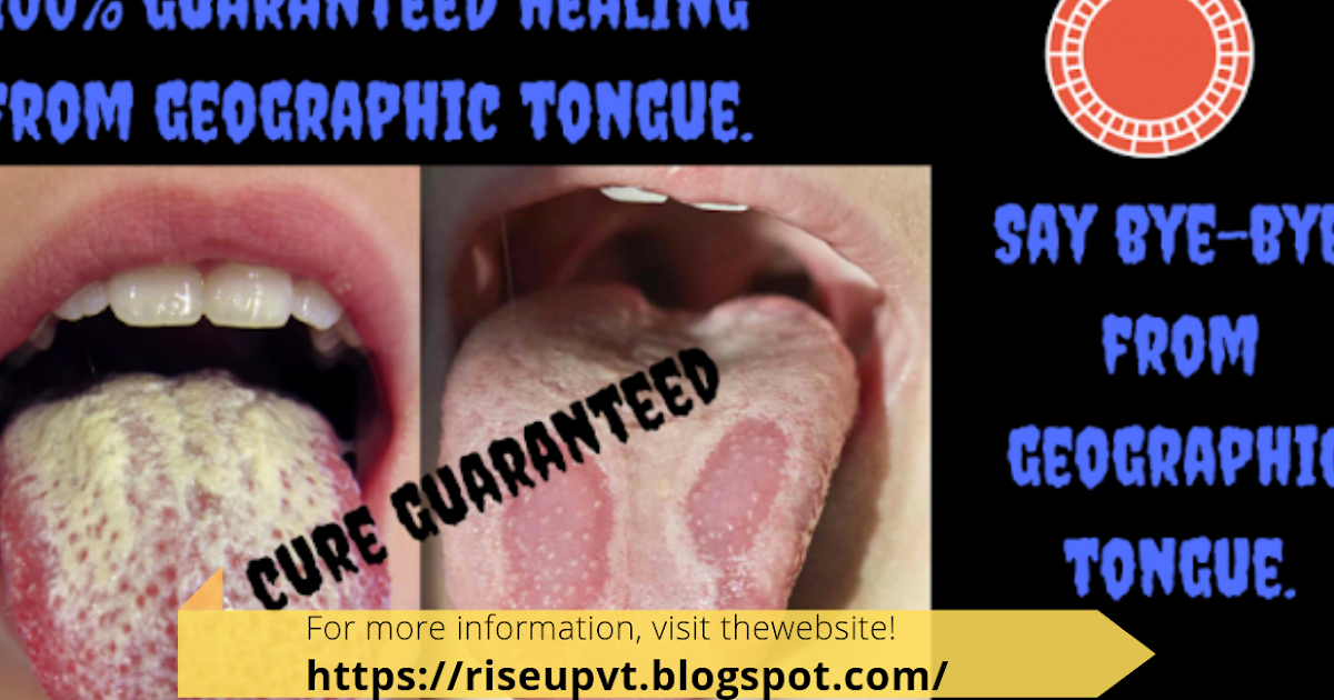 BURNING TONGUE TREATMENT GEOGRAPHIC TONGUE CURE 100 GUARANTEED