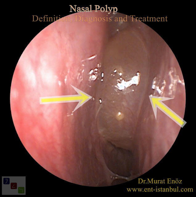 Nasal polyp