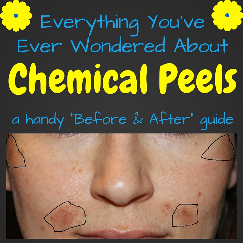 Chemical Peel Before & After