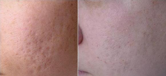 Is TCA Cross, Not TCA Peel, Truly an Effective Method for ...