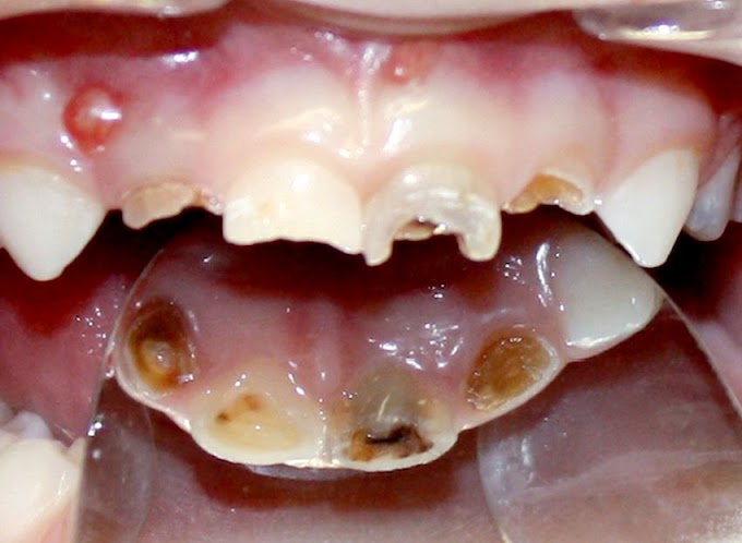 PDF: Como podemos otimizar a endodontia em dentes decíduos? Relato de caso