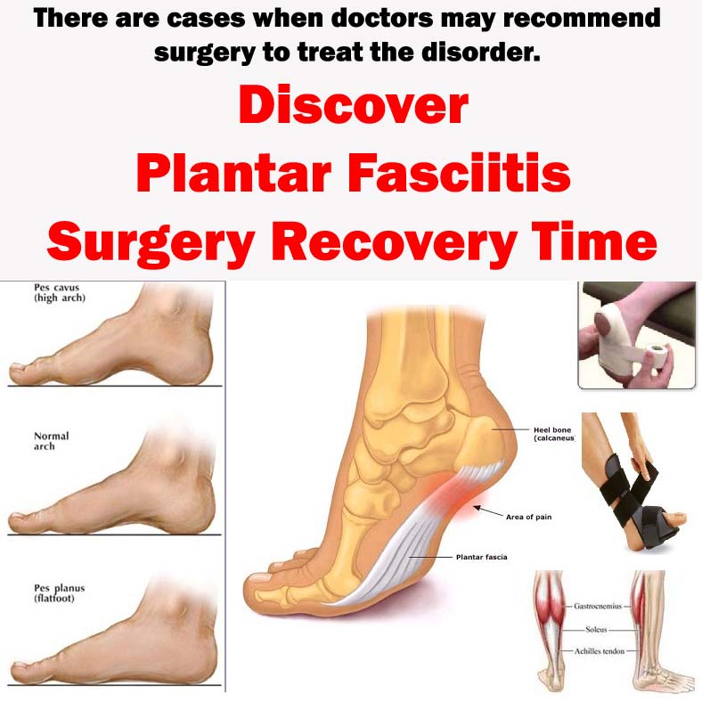 Fast And Effective Solution For Painful Heels Plantar Fasciitis Surgery Recovery Time
