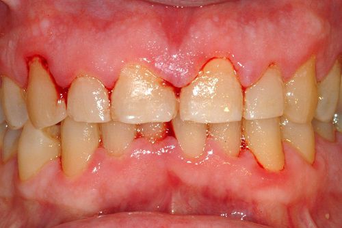 chảy máu chân răng thường xuyên-1