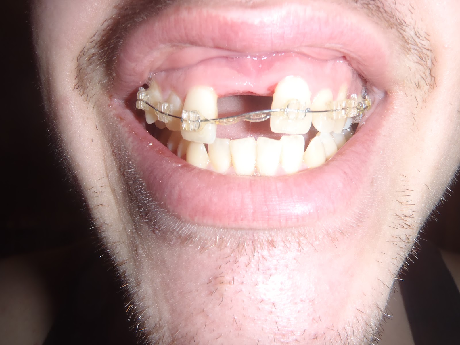 My SARPE Story Stalemate Braces vs The Expander!