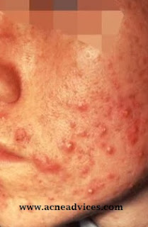 moderate acne pictures