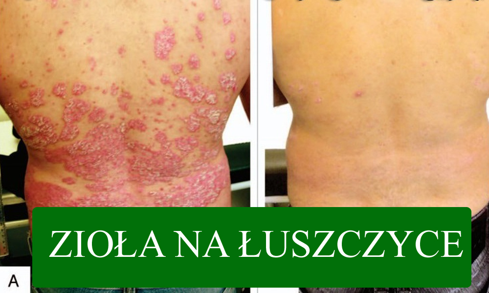 Jakie zioła mogą pomóc w łuszczycy? Zioła na łuszczyce