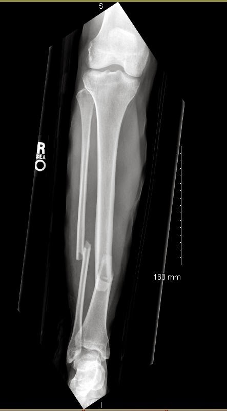 Broken Tibia and Fibula from ATV Accident