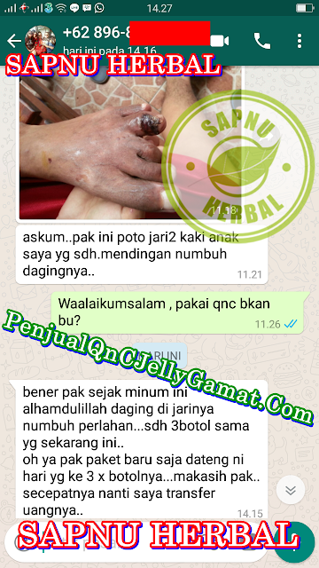 Obat Tradisional Untuk Luka Menganga Obat Tradisional Untuk Luka Menganga