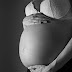 Nausea and Vomiting of Pregnancy