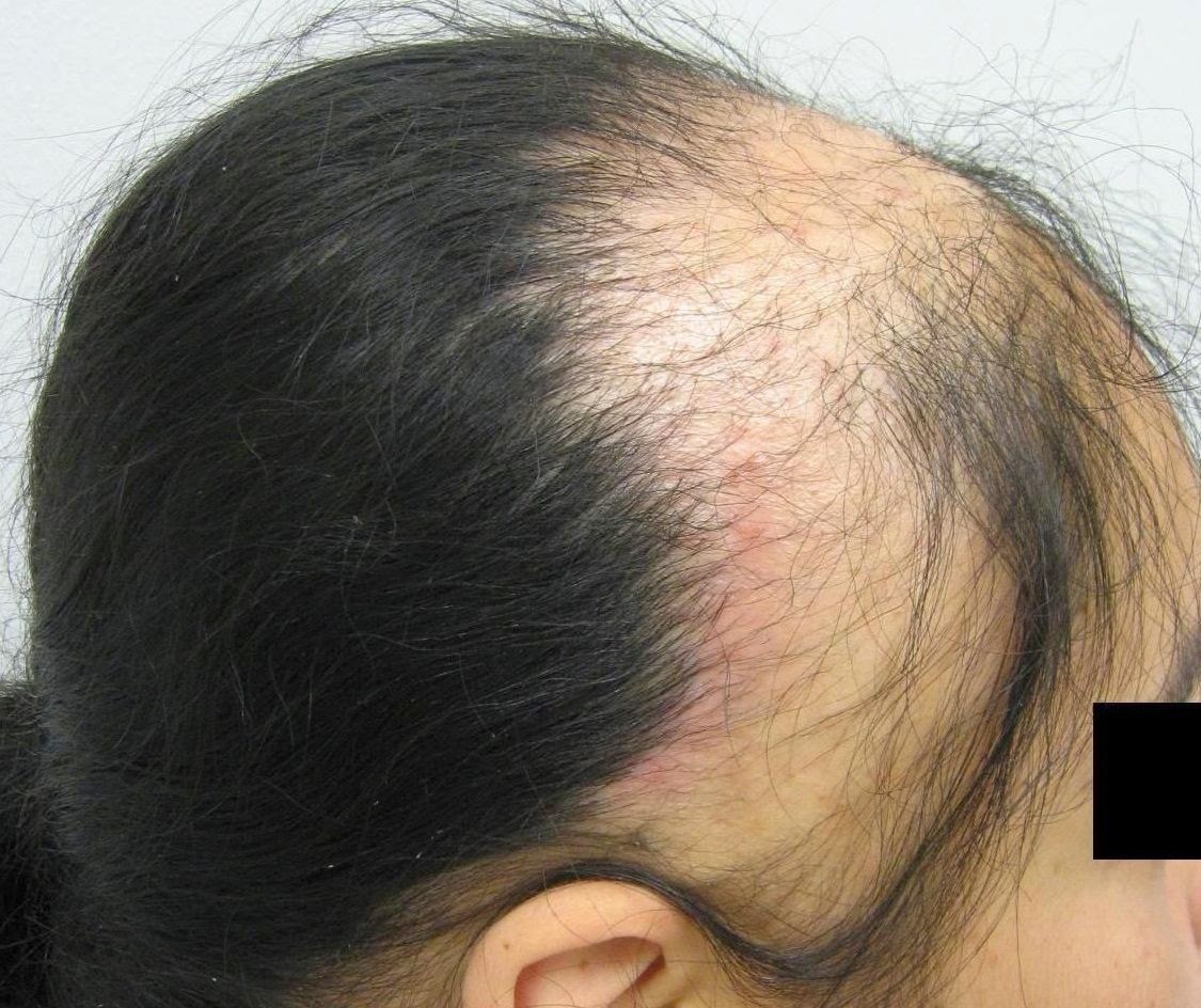 Non Surgical Hair Restoration Traction Alopecia Cure