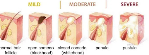 acne types for info