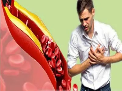 اعراض ارتفاع الكوليسترول وعلاجه