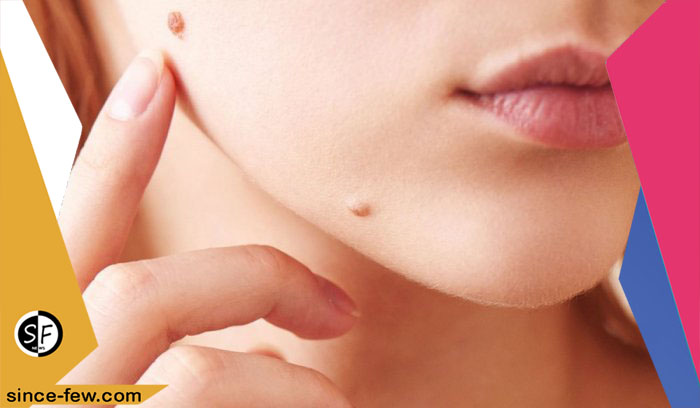 What is Skin Cancer and its Symptoms?