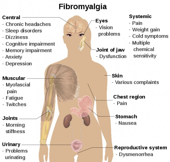 Fibromyalgia symptoms