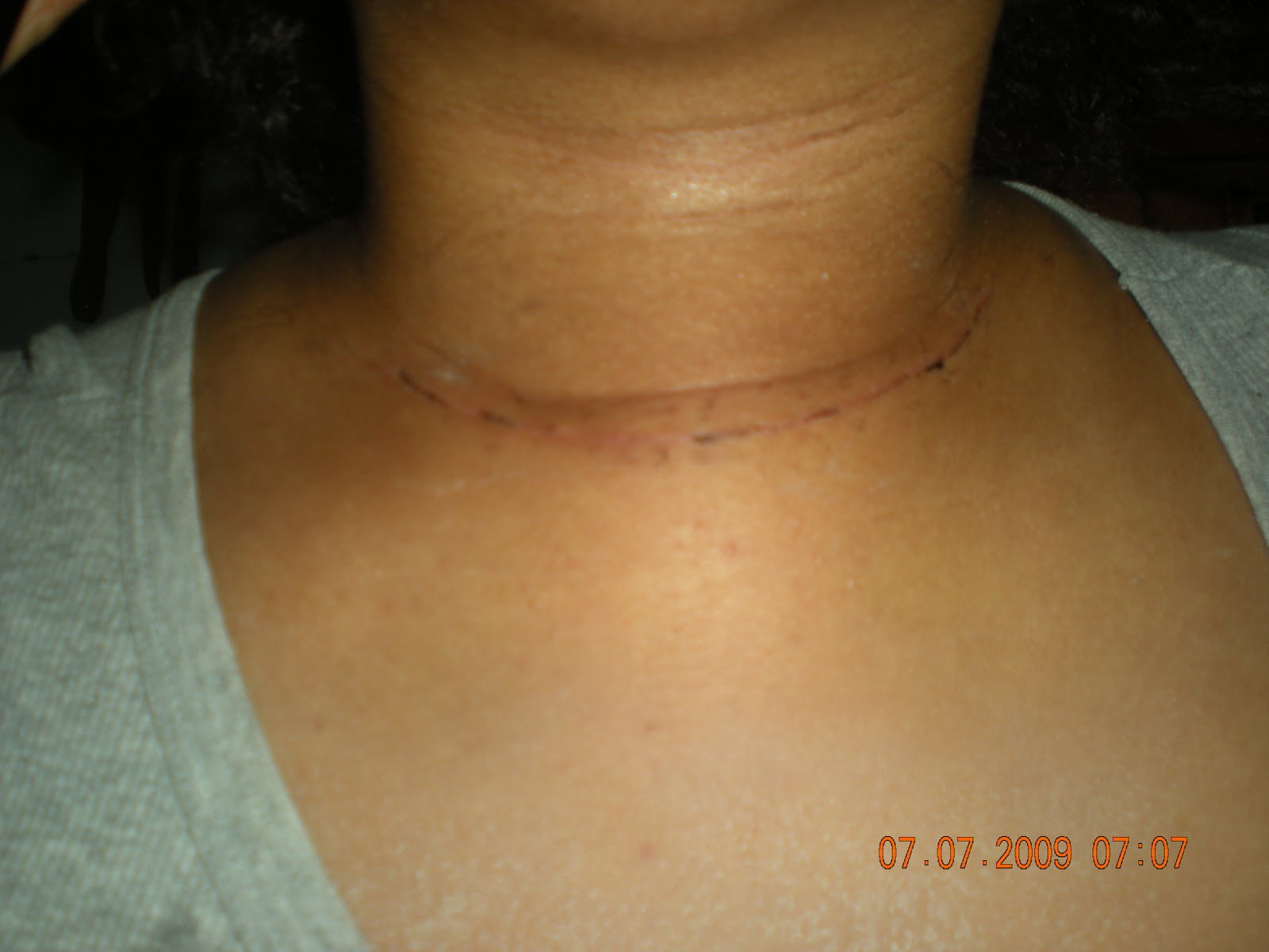 ME AND MY Thyroid!!!! My Thyroid surgery scars