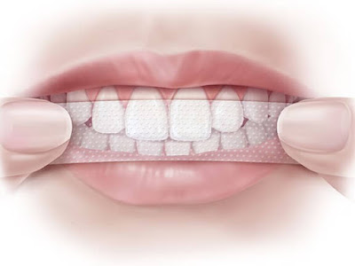 Có nên sử dụng miếng dán trắng răng không? 