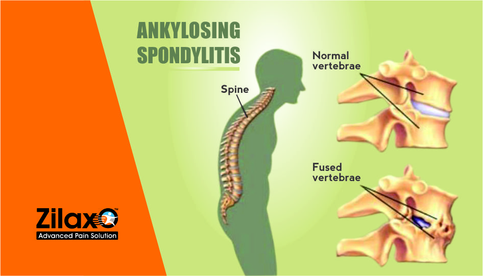 Zilaxo Advanced Pain Solution 7 Easy Exercises For Ankylosing Spondylitis