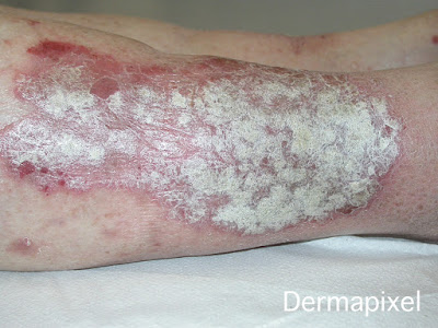 Dermapixel: Dermatitis seborreica: No es piel seca