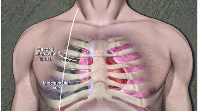 EMS SOLUTIONS INTERNATIONAL by @DrRamonReyesMD marca registrada: Needle ...