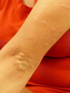 Itchy-Skin-Treatment-in-Hindi, itch-scabies-in-hindi, khaj- khujli -ka- ilaj, दाद -खाज -खुजली - घरेलू - नुस्खे