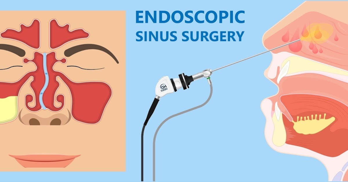 Endoscopic Sinus Surgery