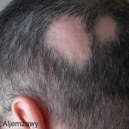 14 Effective ways to treat alopecia naturally