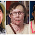 Mujer recibe segundo trasplante de cara en EE. UU.