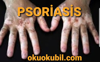 Sedef hastalığı nedir Kaç Çeşit Sedef Hastalığı Vardır? Psoriasis