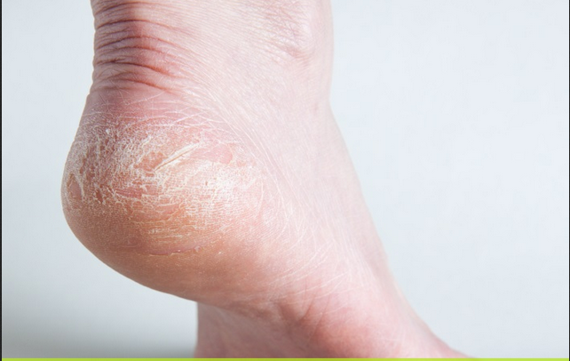 Cracked Heels Causes Symptoms Home Remedies Treatment Prevention Useful Information