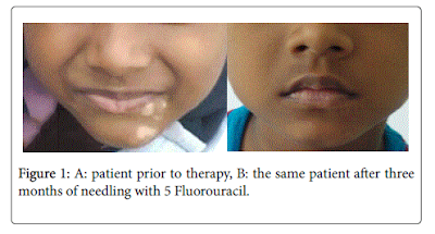 Tratamiento Exitoso del Vitiligo por Punción con 5 Fluorouracilo Topical-Caso 1