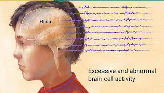  merupakan jenis penyakit saraf menahun yang menjadikan kejang Ramuan Alami Untuk Penyakit Epilepsi