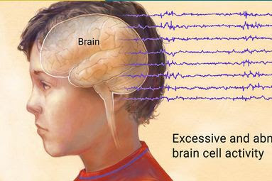 Ramuan Alami Untuk Penyakit Epilepsi