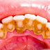 Vôi răng có tác hại gì đến răng miệng