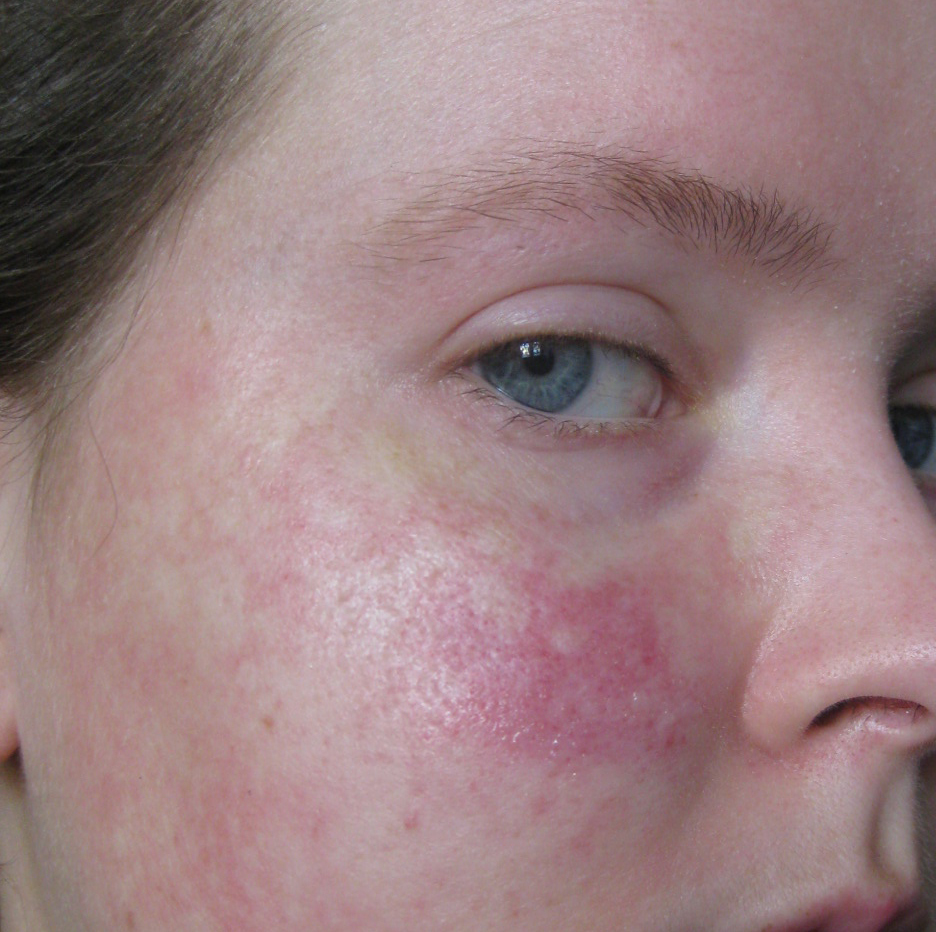 Scarlet Letters, dealing with vascular rosacea, face flushing, burning
