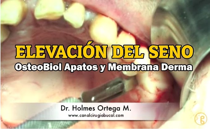 ELEVACIÓN DE SENO: OsteoBiol Apatos y Membrana Derma - Dr. Holmes Ortega