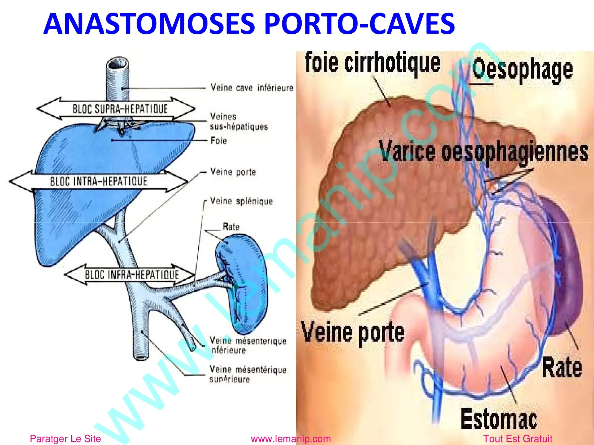 Anastomoses Porto Caves