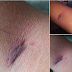 Female corp member in Ekiti brutalized for not wearing the complete NYSC uniform shares photos of her injury, recounts her experience