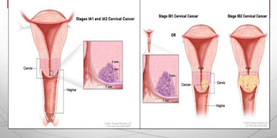ung thư cổ tử cung giai đoạn 1