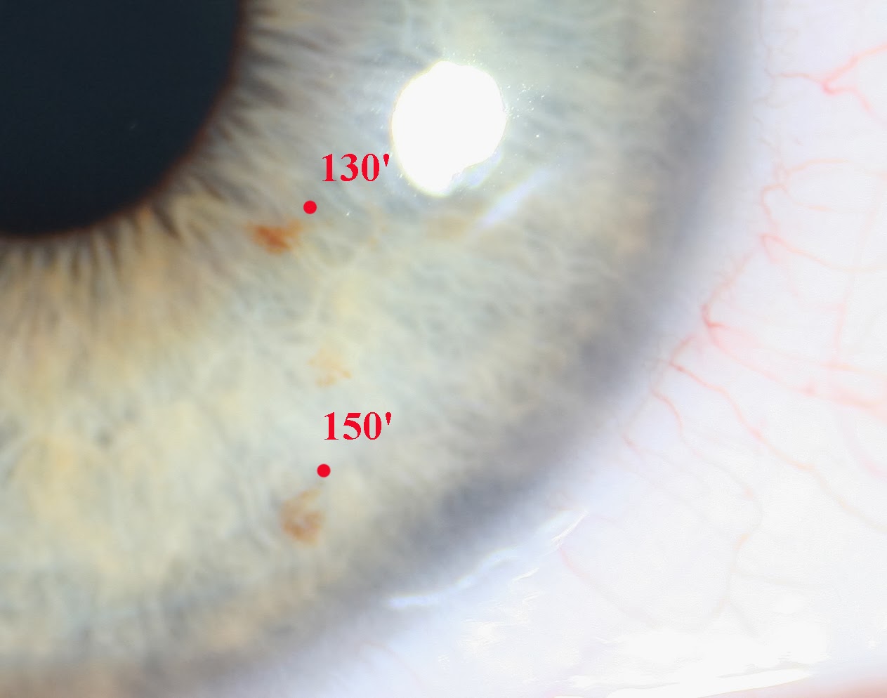 Modern & Multidimensional Iridology Prioritize of Iris Pigments in
